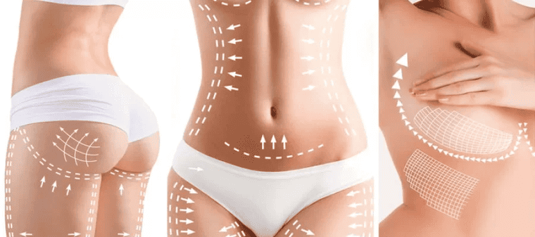 Mommy makeover surgery