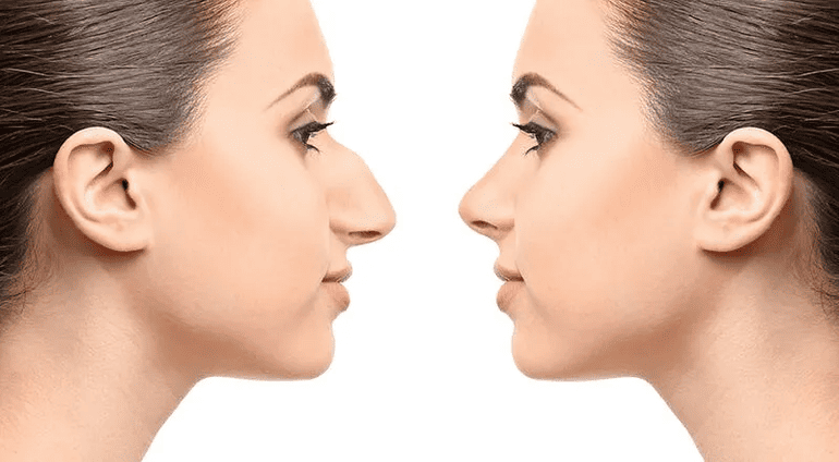 Rhinoplasty procedure