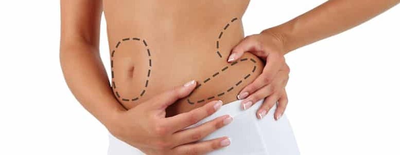 Liposuction fat removal surgery