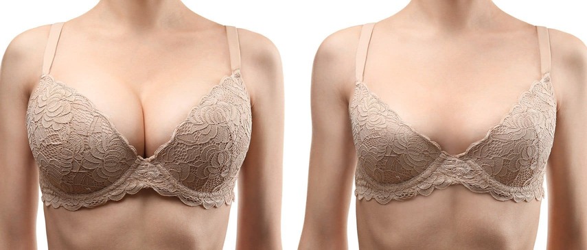 Breast reduction surgery